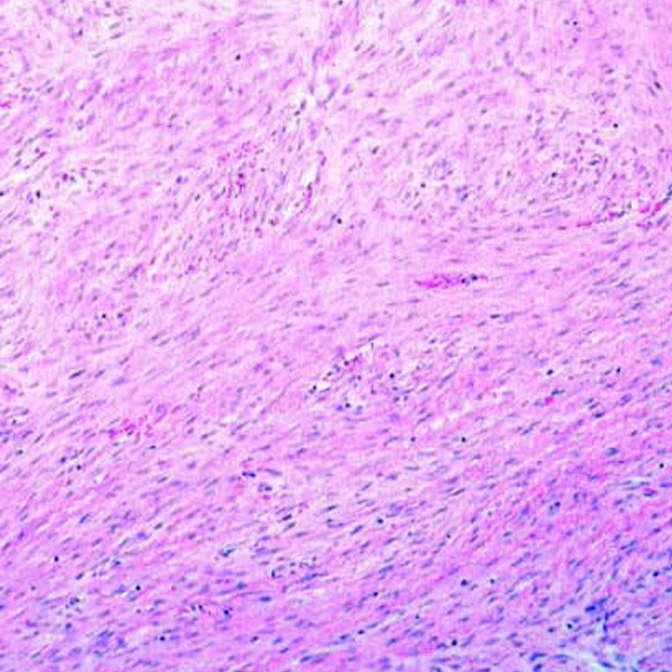 Conventional histologic pattern