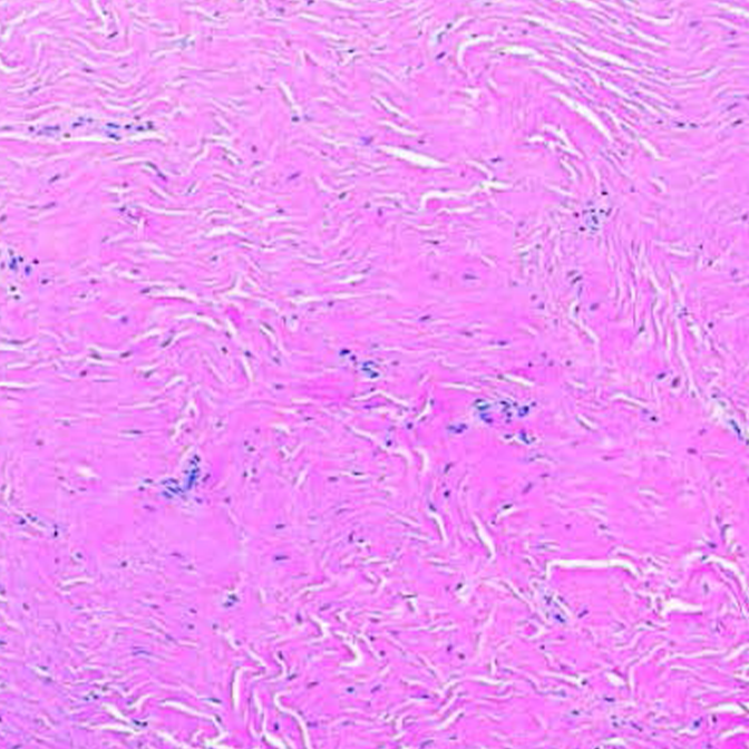 Hypocellular/hyalinized histologic pattern