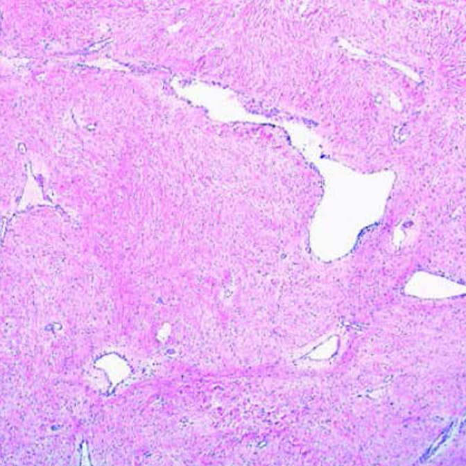 Staghorn vessel histologic pattern