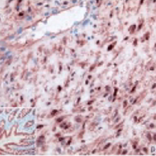 Desmoid tumor with nuclear beta-catenin staining