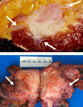 Gross tumor specimens