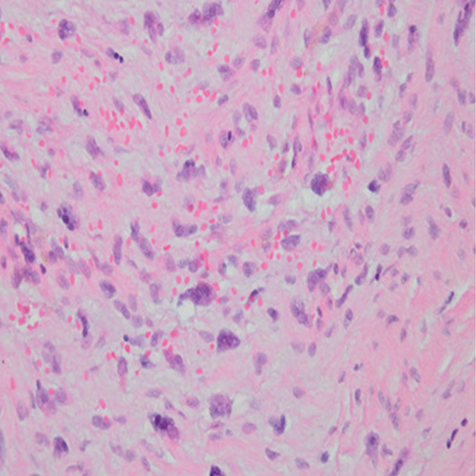 Fibromyxoid sarcoma with focal nuclear atypia