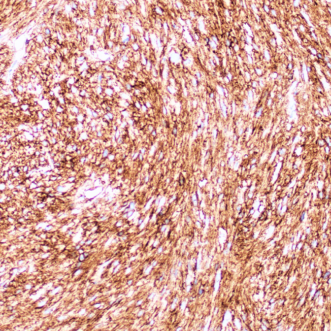 GIST with DOG1 staining