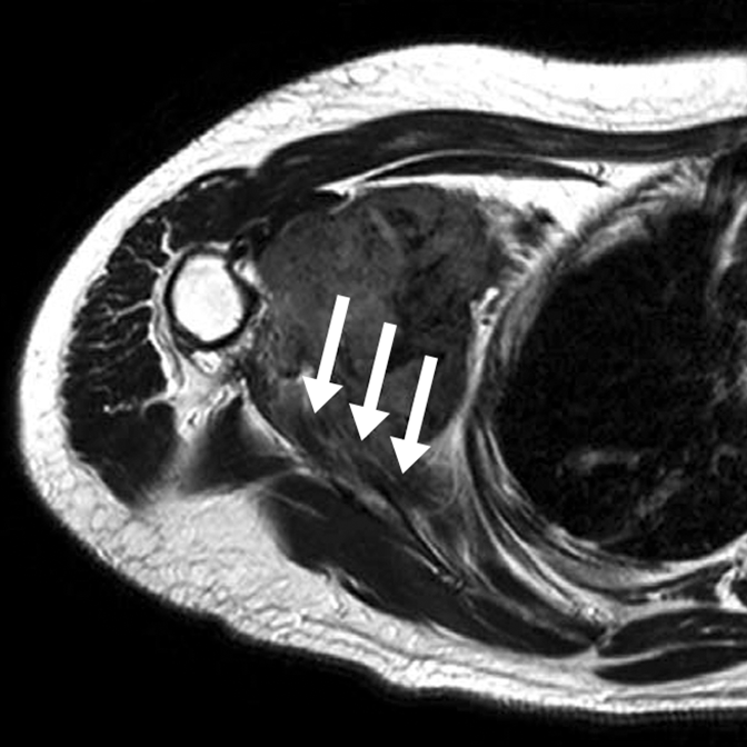 MRI scan of a desmoid tumor