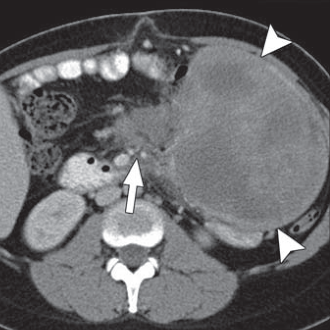 CT scan of a desmoid tumor