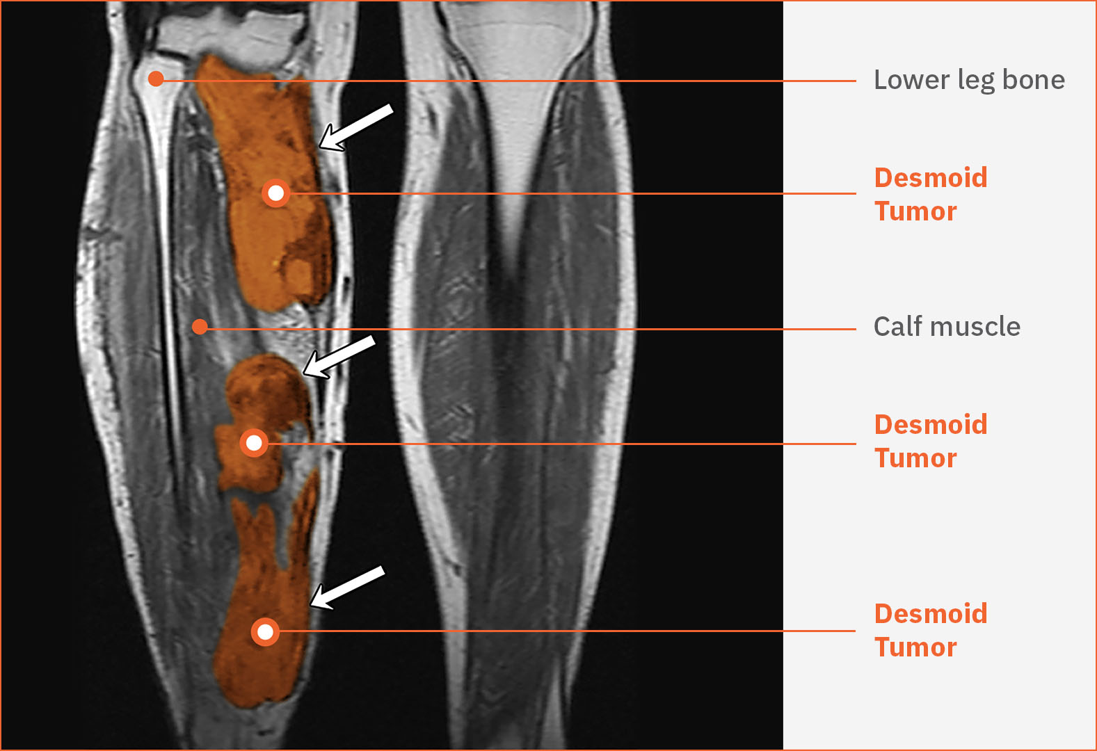 What is a desmoid tumor? Springworks