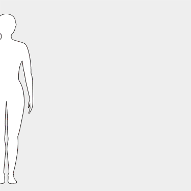 Animated diagram showing common desmoid tumor locations and symptoms on the body.